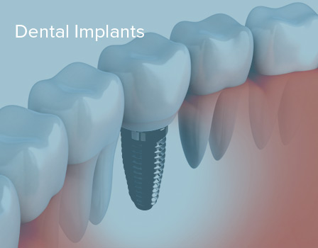 Dental Implants