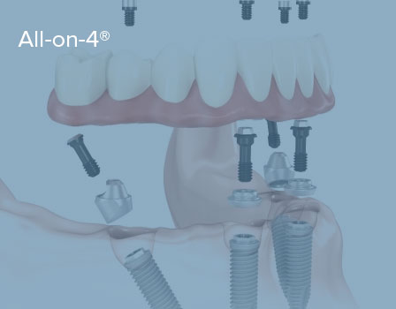 All-on-4®